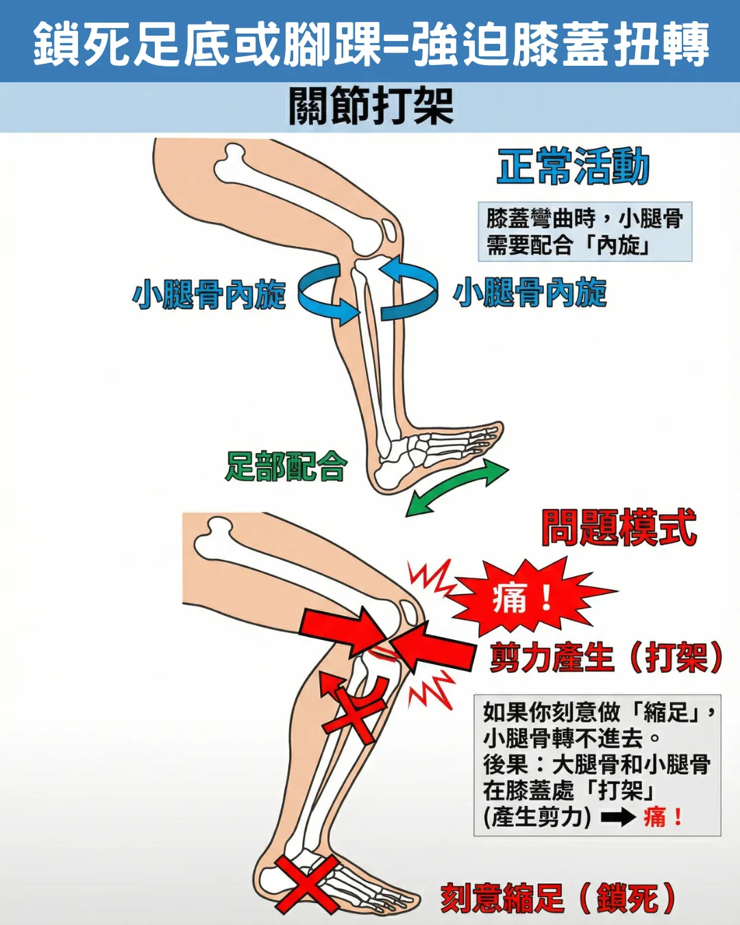 深蹲膝蓋痛原理-脛骨內旋不足導致剪力