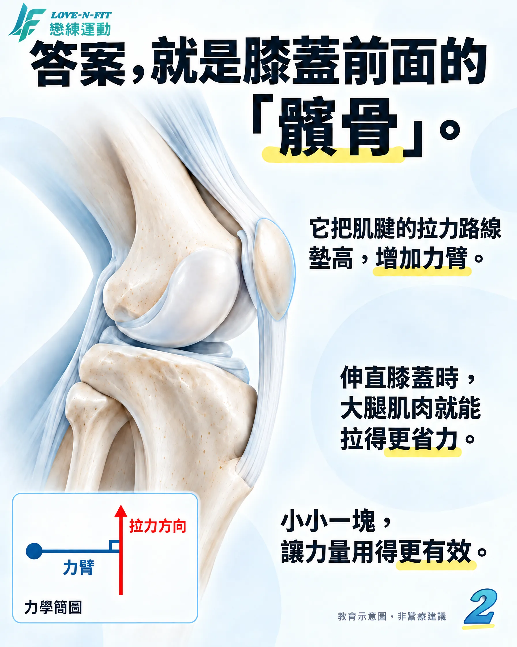 髕骨墊高肌腱拉力路線並增加伸膝力臂的簡化示意圖