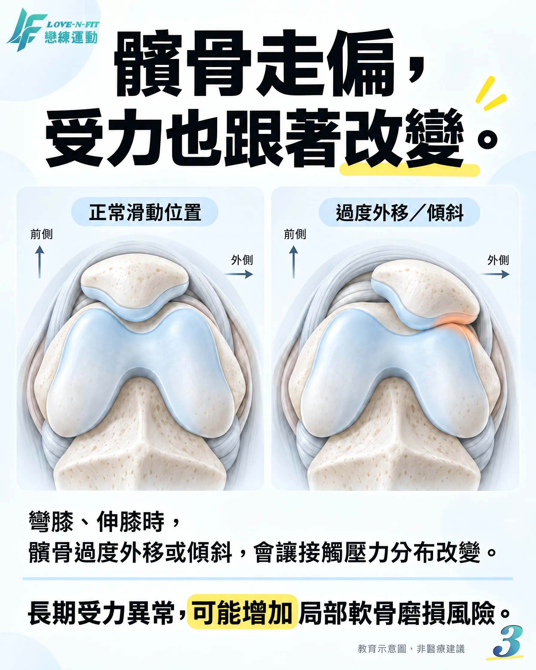 正常髕骨滑動與外移或傾斜狀況的對照圖卡